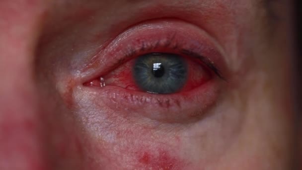 Nahaufnahme eines schweren blutverschmierten Auges. Blepharitis, Bindehautentzündung — Stockvideo