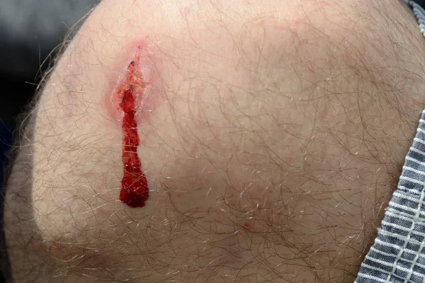 Bleeding knee injury — Stock Photo, Image