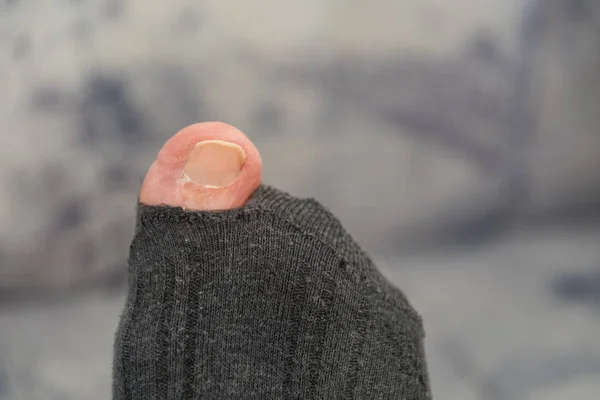 Agujero en calcetín muestra dedo del pie — Foto de Stock