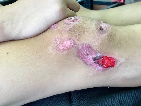 Rány na kůži kolena dítě kvůli pádu Stock Snímky