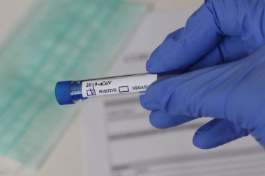 Kavramsal fotoğrafçılık, koronavirüs testi. Elinde hastanın numunesinin olduğu bir test tüpü var. Analizin sonucu pozitiftir. Tadı Coronavirus COVID-19 için pozitif çıktı..