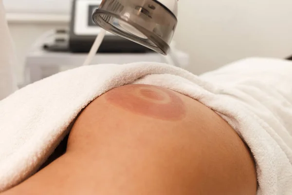 Cosmetologo Glutei Procedura Massaggio Sottovuoto Primo Piano Del Cliente Medico — Foto Stock