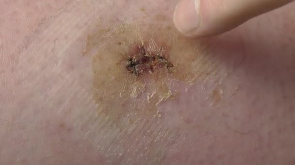 Состояние Раны После Удаления Хирургического Шва Extra Clous Body Area — стоковое видео