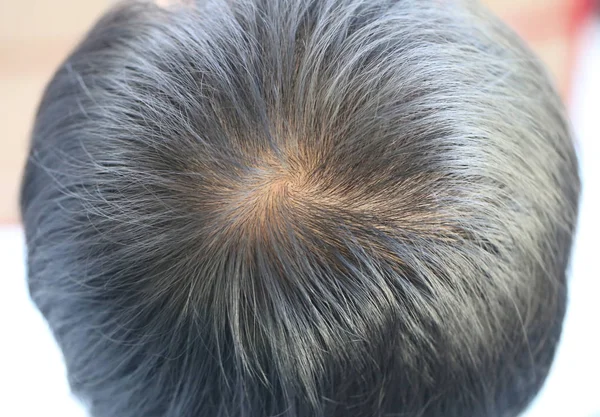 Concentrarsi sul perdere i capelli di un uomo . — Foto Stock