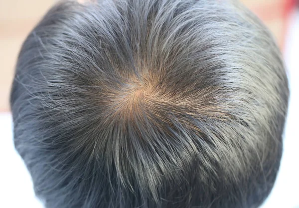 Fokus pada kehilangan rambut seseorang seorang pria . — Stok Foto