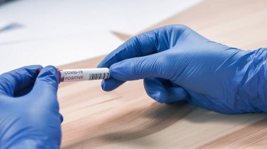 Coronavirus enfekte olmuş örnek testi