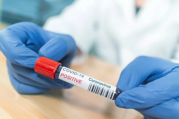 Teste de esfregaço infectado pelo coronavírus — Fotografia de Stock