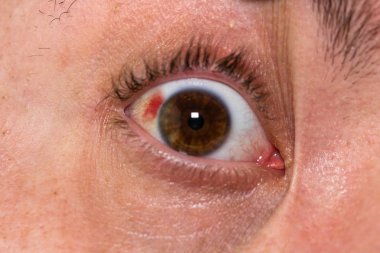 Göz yaralanması, gözlerinde kan damarı patlamış genç adam, yorgunluk, p