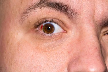 Göz yaralanması, gözlerinde kan damarı patlamış genç adam, yorgunluk, p
