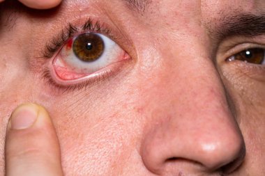Göz yaralanması, gözlerinde kan damarı patlamış genç adam, yorgunluk, p