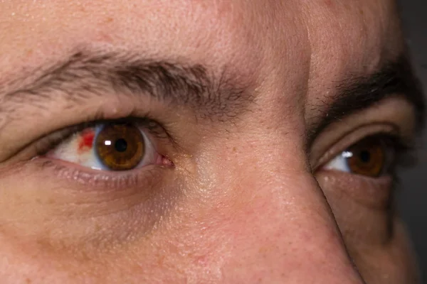 Lesión ocular, hombre joven con un vaso sanguíneo reventado en el ojo, fatiga, p — Foto de Stock