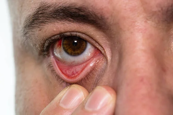 Göz yaralanması, gözlerinde kan damarı patlamış genç adam, yorgunluk, p