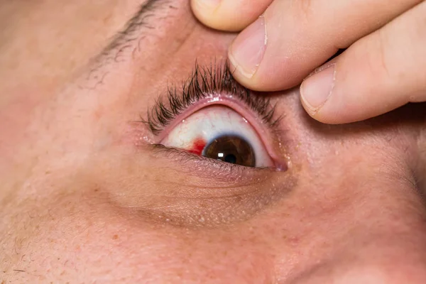 Lesión ocular, hombre joven con un vaso sanguíneo reventado en el ojo, fatiga, p — Foto de Stock