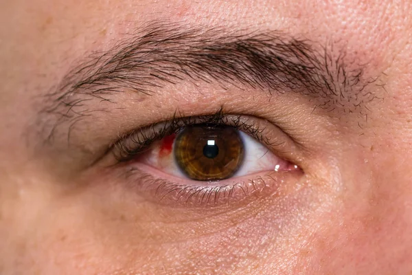 Травма глаза, молодой человек с разрывом кровеносных сосудов в глазах, усталость, р — стоковое фото