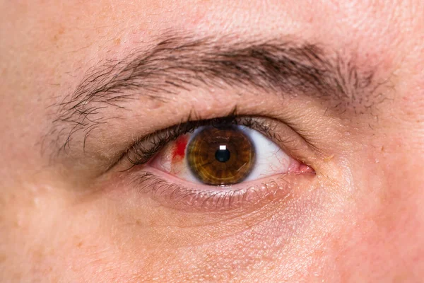 Lesión Ocular Hombre Joven Con Vaso Sanguíneo Reventado Ojo Fatiga — Foto de Stock