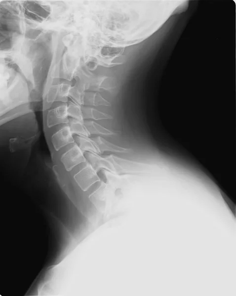 X-ray scan of a human neck - cervical vertebrae
