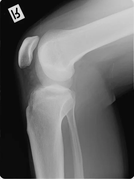 Röntgenbild Eines Angewinkelten Rechten Beines Einschließlich Kniescheibe Stockbild