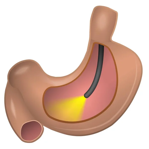 Gastroskopie Farb Symbol Vektor Magen Abbildung Auf Weiß — Stockvektor