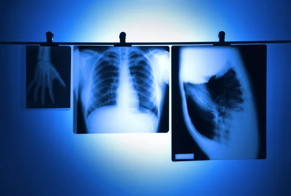 Lung X-ray and hand hanging negatives — Stock Photo, Image