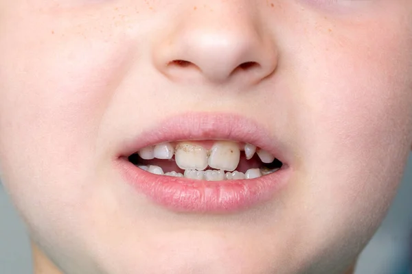 Tandheelkundige Geneeskunde Gezondheidszorg Kleine Jongen Patiënt Open Mond Tonen Cariës — Stockfoto