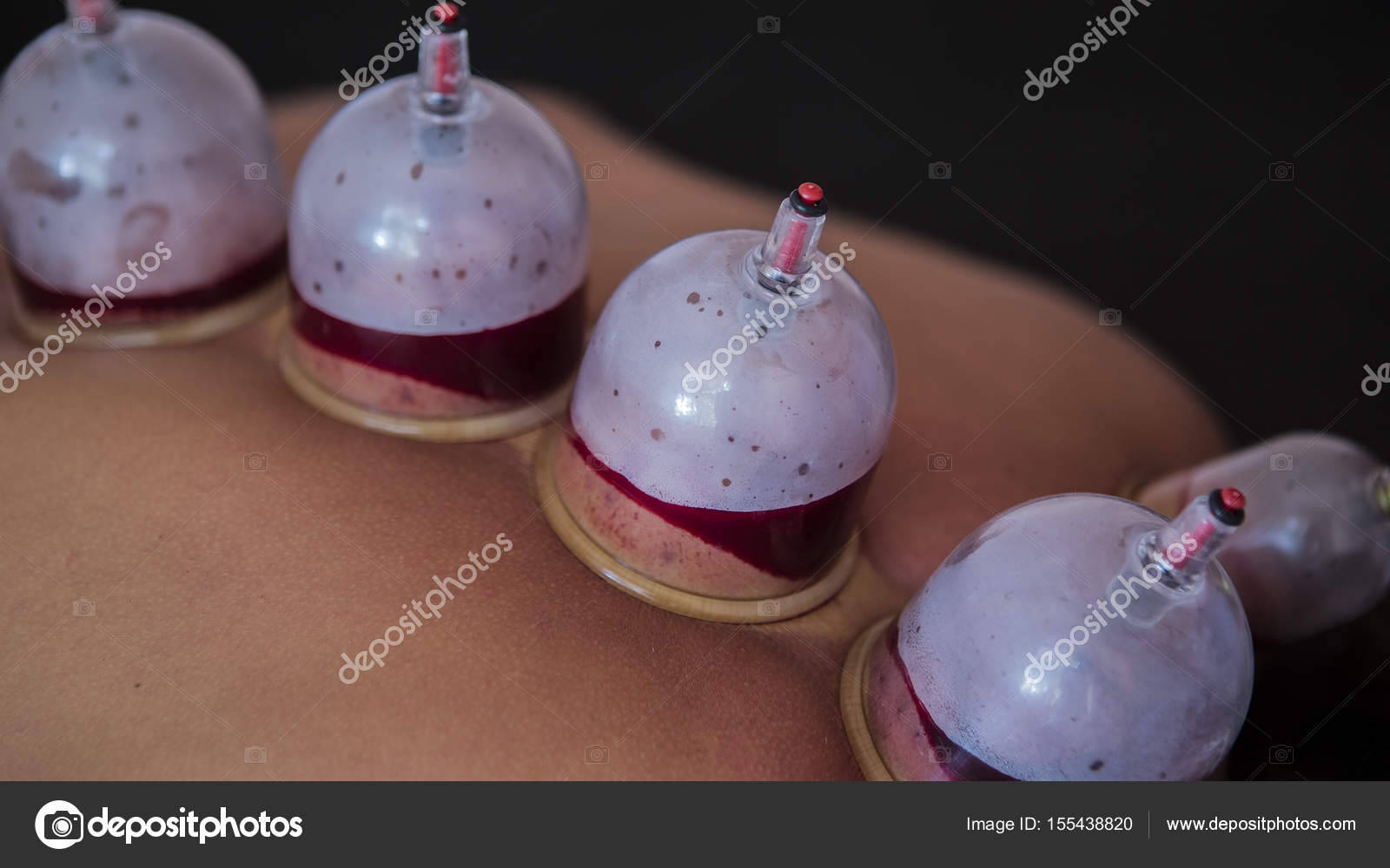 Cupping Therapy Chinese History