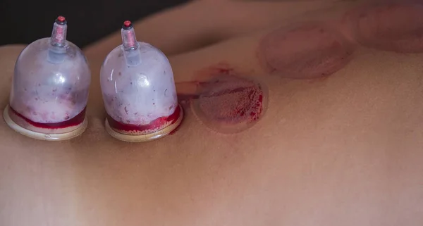 Traditional Chinese Medicine Cupping process.