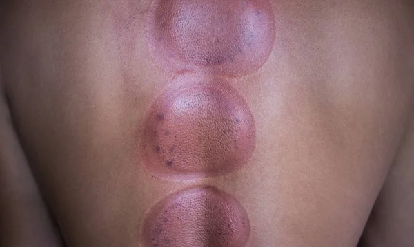 Traditional Chinese Medicine Cupping process.