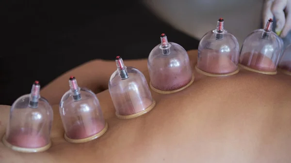 Traditionele Chinese geneeskunde Cupping proces. — Stockfoto
