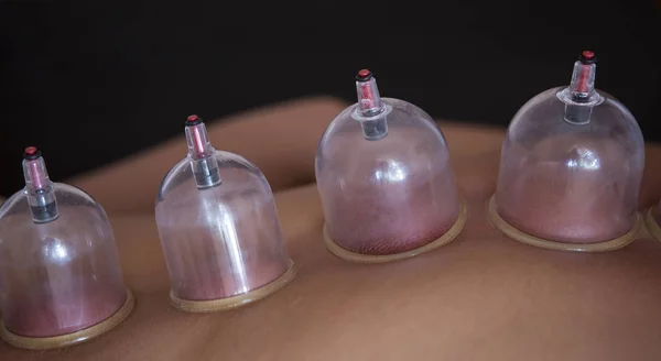 Traditional Chinese Medicine Cupping process.