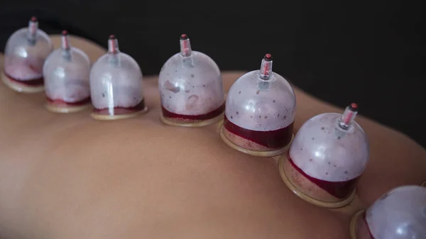 Traditionele Chinese geneeskunde Cupping proces. — Stockfoto
