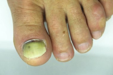 Damaged toenail. The thumb on the mans leg. Ugly, injured and broken nail on the foot. clipart