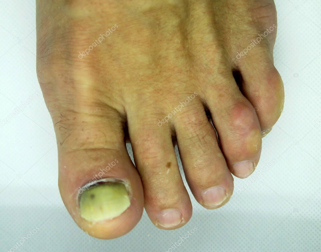 Damaged toenail. The thumb on the man's leg. Ugly, injured and broken nail on the foot.