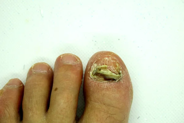 Nail fungus on legs. Nail disease. Ugly nails — Stock Photo, Image