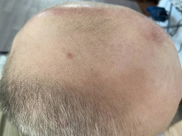 Middle-aged man concerned with hair loss. Baldness. Top view Obraz Stockowy