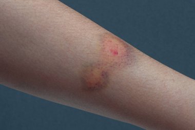 Bir kadının kolundaki renkli bir çürüğe yakın dur.