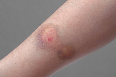 Bir kadının kolundaki renkli bir çürüğe yakın dur.