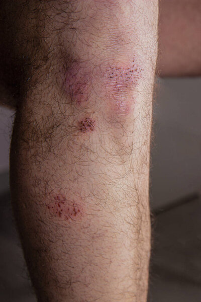 bruise and bruise on a man knee.