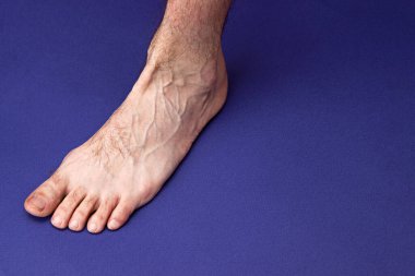 Genişlemiş varis damarları olan bir adam ayağı mavi bir arka planda duruyor.