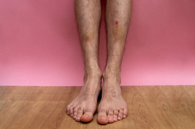 Pembe arka planda genç bir adamın bacağında pıhtılaşmış kan izleri var.