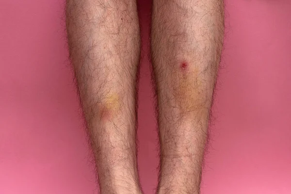 Bruise Clotted Blood Leg Young Man Pink Background — Stock Photo, Image