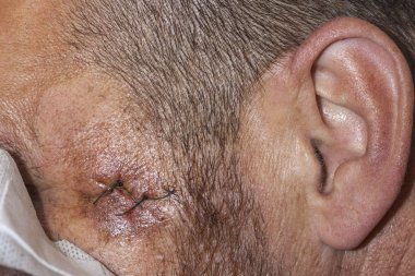 Medical sutures on the face after surgery on the temporal bone. Suture wound at the temple. Stitched skin on the face of a young man after surgery clipart