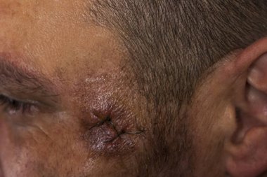 Şakak kemiğindeki ameliyattan sonra yüzünde tıbbi dikiş izleri var. Şakaktaki dikiş yarası. Ameliyattan sonra genç bir adamın yüzüne dikiş atılmış.