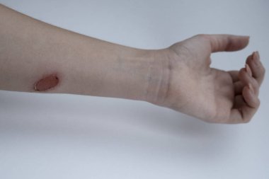 Beyaz arka planda bir kadının ikinci derece yanığı.