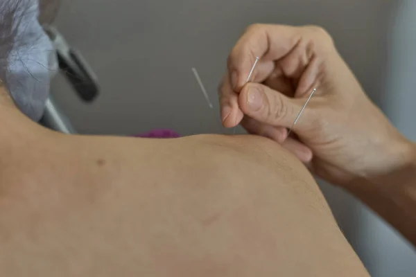 The doctor sticks needles into the woman\'s shoulder on the acupuncture - close up