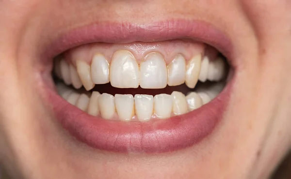 Dientes Femeninos Cerca Sobre Fondo Aislado — Foto de Stock