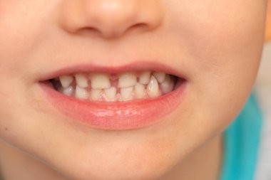 bebek beyaz dişler yakından, gülümseyen küçük çocuk