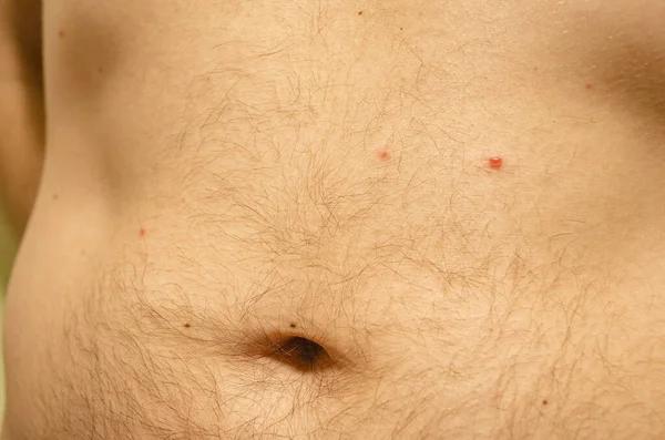 Ανεμοβλογιά Ακμή Στο Δέρμα Ενός Άντρα Κοντινό Πλάνο Εμφάνιση Της — Φωτογραφία Αρχείου