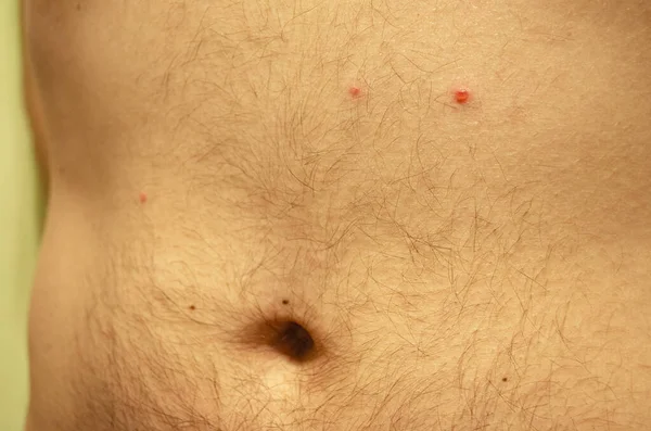 Varicella Acne Sulla Pelle Uomo Primo Piano Insorgenza Della Malattia — Foto Stock