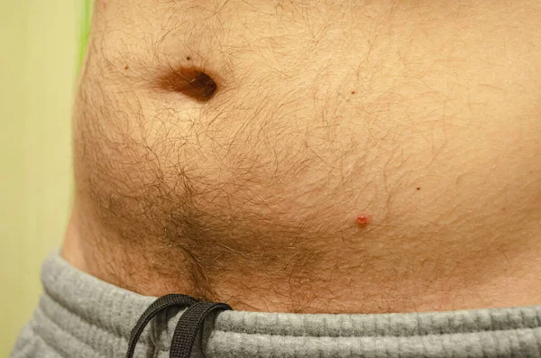 Varicela Acne Pele Homem Close Início Doença Temperatura — Fotografia de Stock