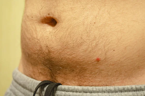 Chickenpox Acne Skin Man Close Onset Disease Temperature — Stock Photo, Image